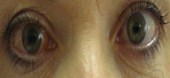 Glaucoma, una ceguera irreversible