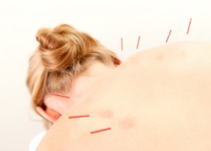 Acupuncture Patient Treatment in Back