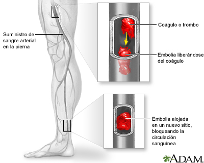 La hinchazón de piernas puede significar embolias.