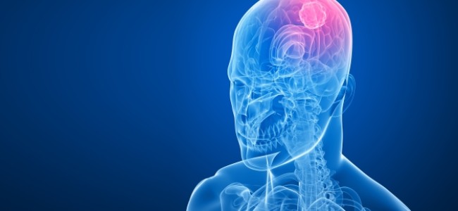 ¿Sabías que existen más de 100 tipos de tumores de cerebro y cuál es su primer síntoma?